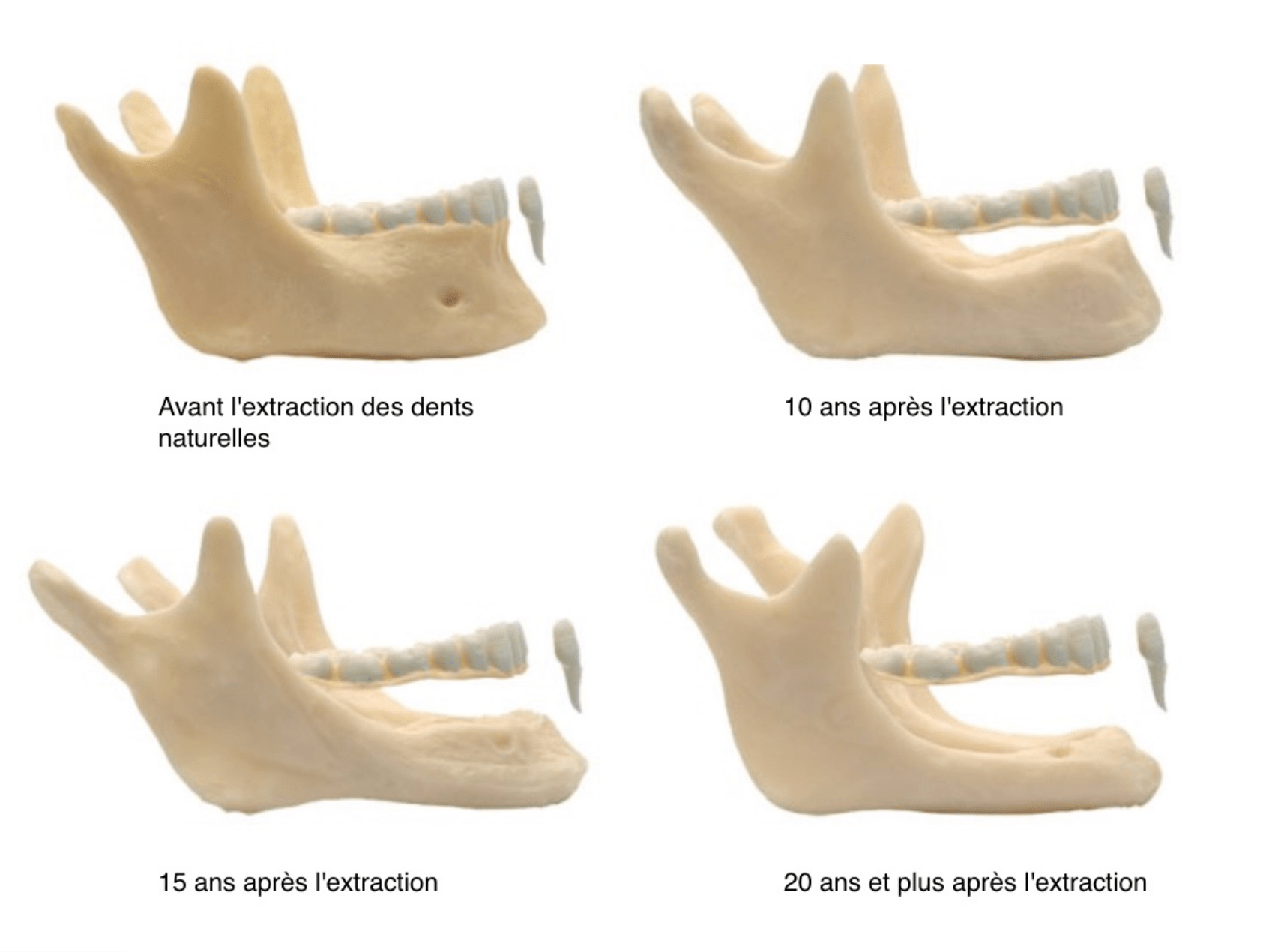 atrophie osseuse