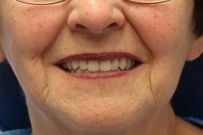 prothèses dentaires complètes